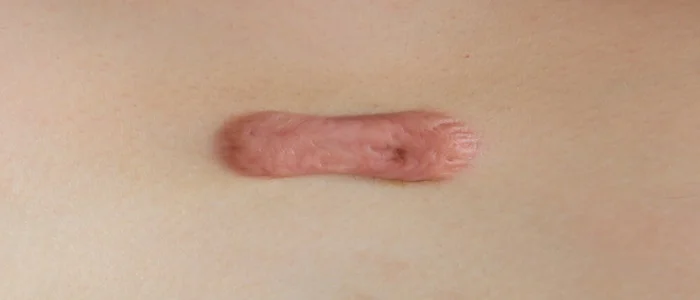 Especialista em cirurgia plástica explica os tratamentos para queloide
