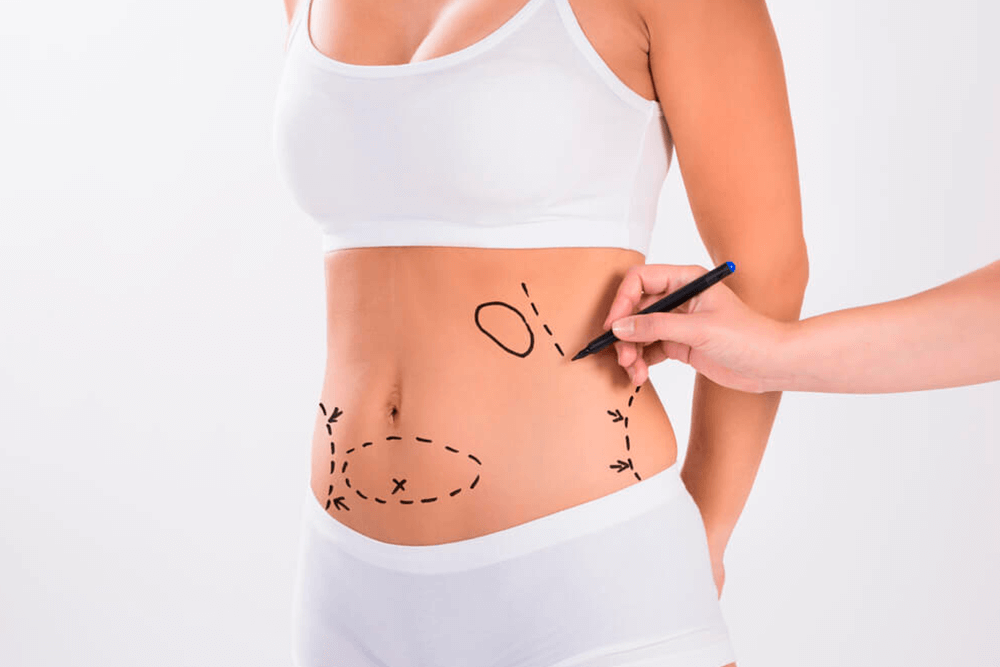 Como é a recuperação da abdominoplastia?