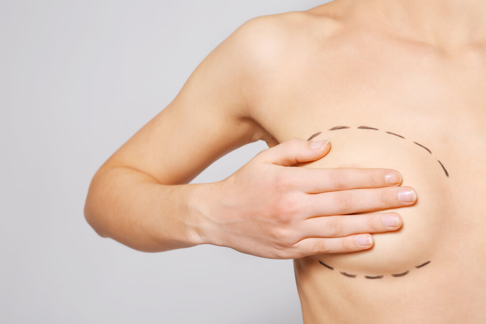 Qual o tempo de recuperação da cirurgia de mamoplastia?