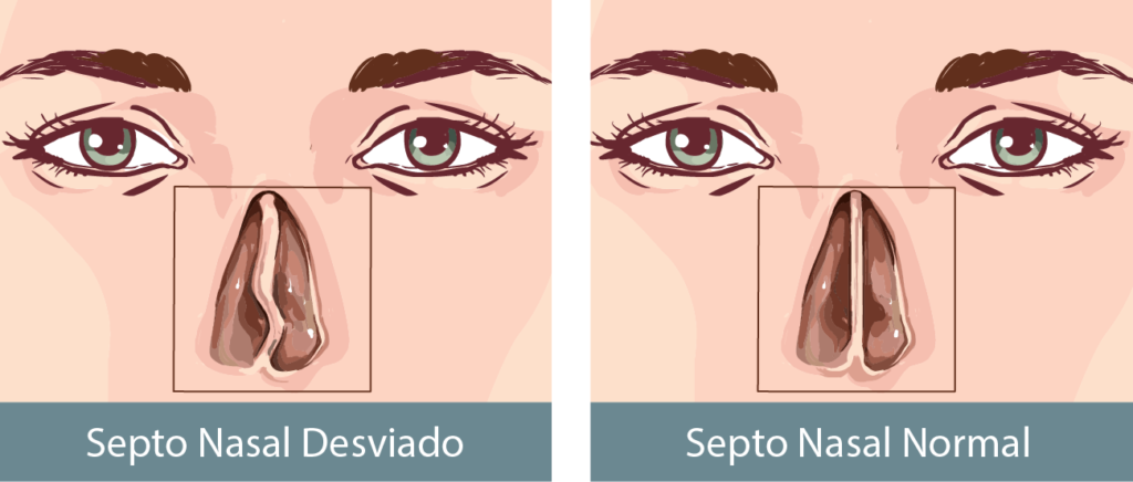 Cirurgia para o desvio de septo