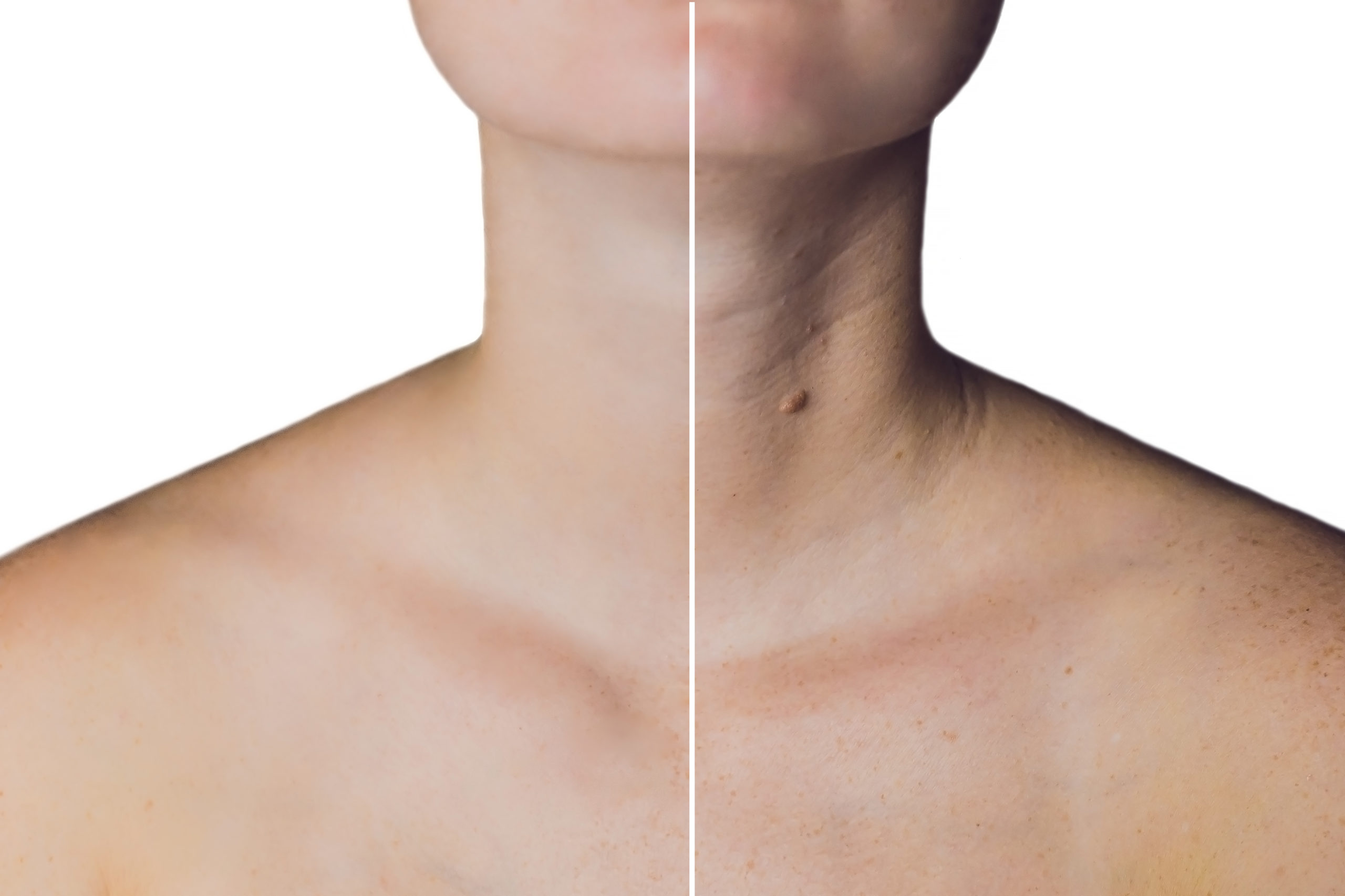 Entenda como o Botox pode recuperar a aparência jovial do seu pescoço sem intervenção cirúrgica.