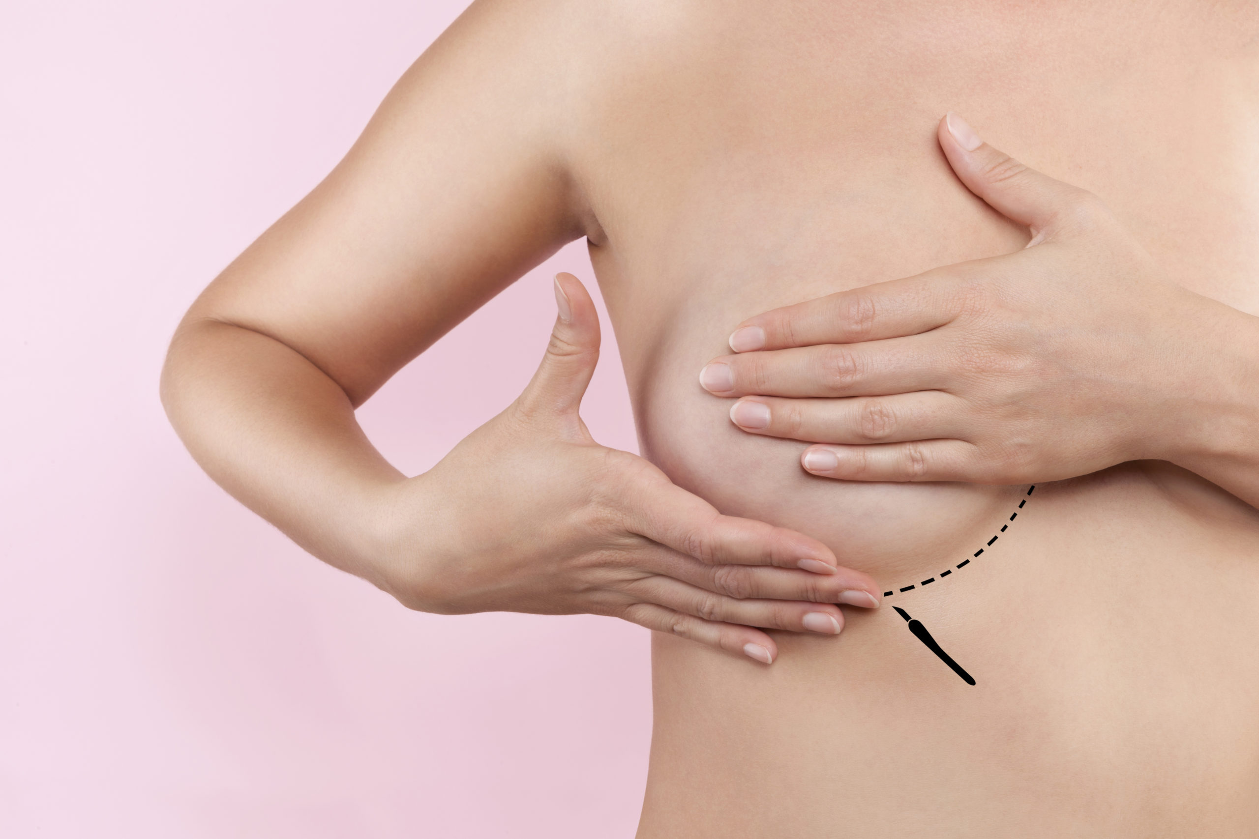 Quais são os tipos de mamoplastia?