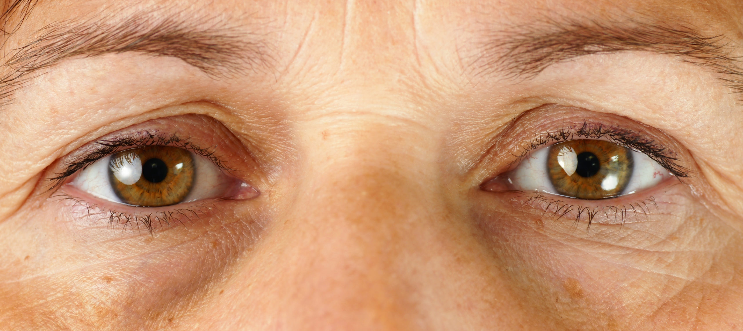Tratamentos para rejuvenescer a região dos olhos