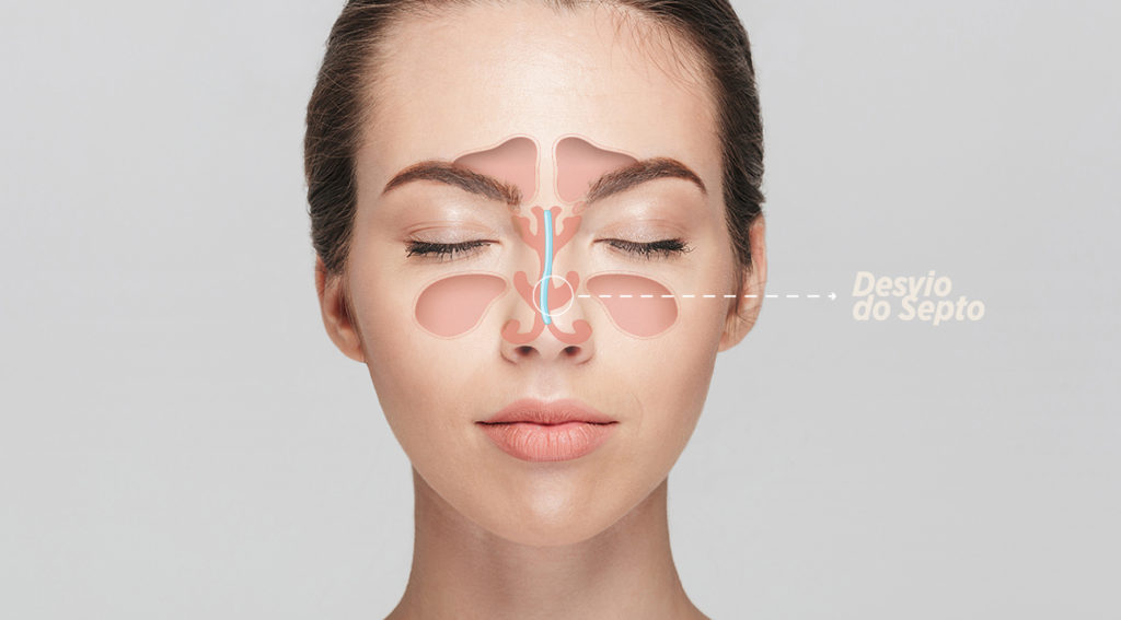 Desvio de Septo – Problemas e soluções