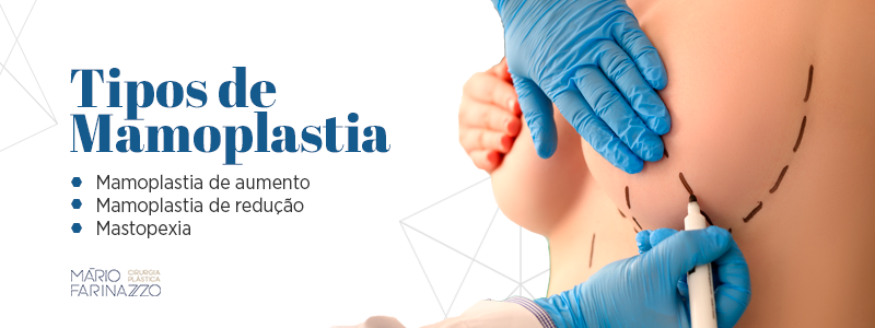 Tipos de Mamoplastia: Mamoplastia de aumento, Mamoplastia de redução e Mastopexia.