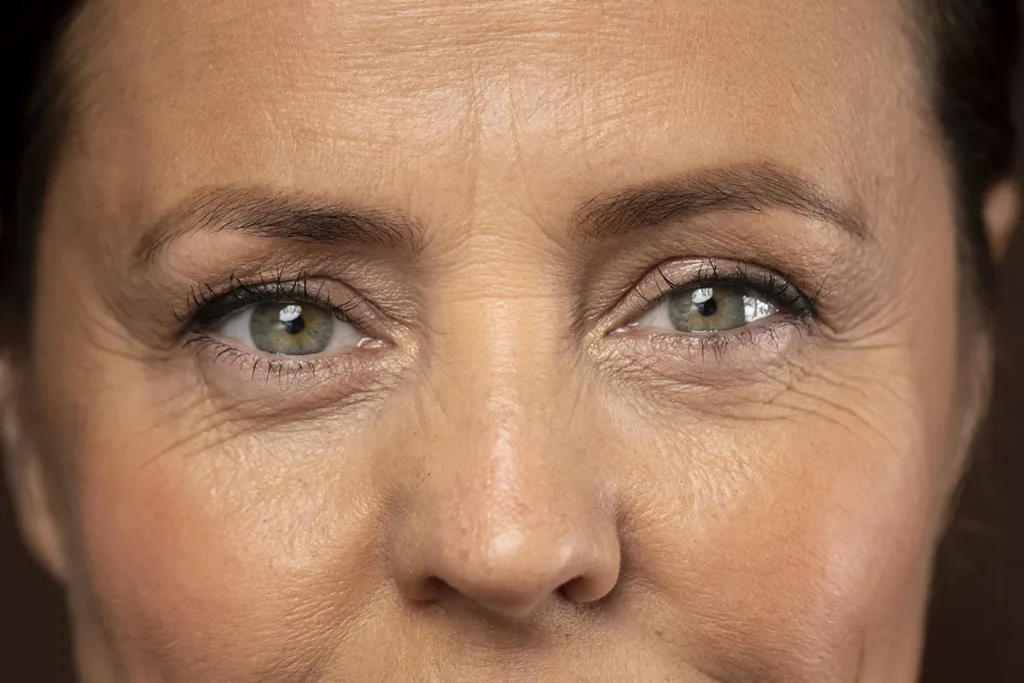 Blefaroplastia melhora bolsas nos olhos?