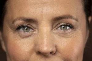 Blefaroplastia melhora bolsas nos olhos?